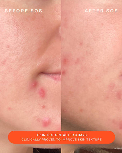 Tower 28 - SOS Daily Skin Barrier Redness Recovery Moisturizer