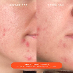 Tower 28 - SOS Daily Skin Barrier Redness Recovery Moisturizer