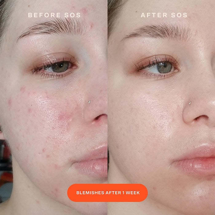 Tower 28 - SOS Intensive Redness Relief Serum