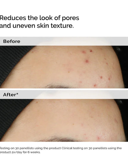 The Ordinary 
Balancing & Clarifying Serum for Blemish-Prone Skin
