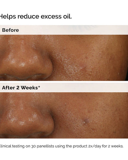 The Ordinary 
Balancing & Clarifying Serum for Blemish-Prone Skin