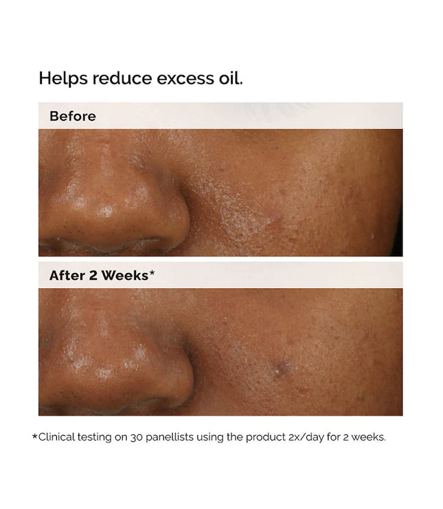 The Ordinary 
Balancing & Clarifying Serum for Blemish-Prone Skin